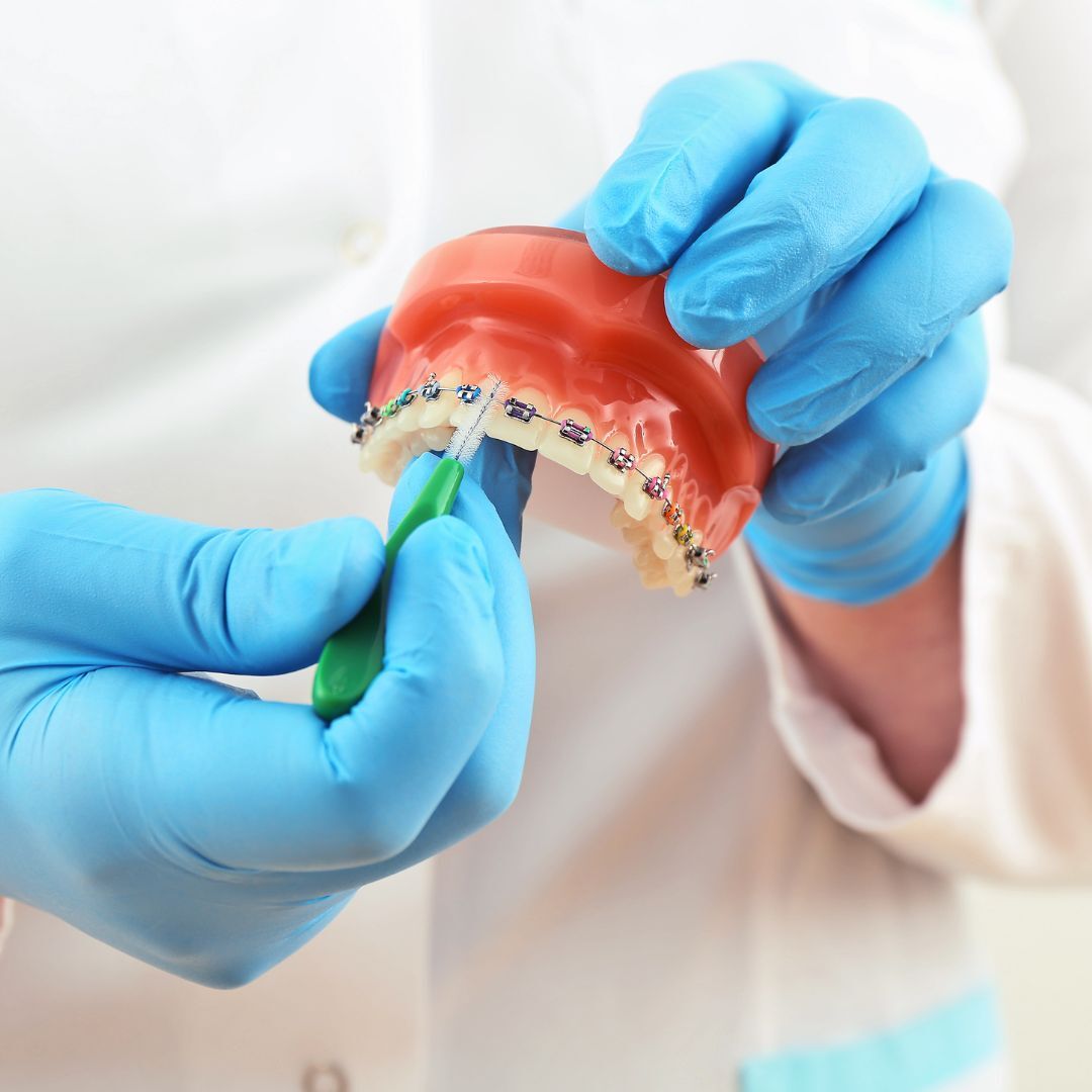 Doctor holding a set of top teeth with braces on 